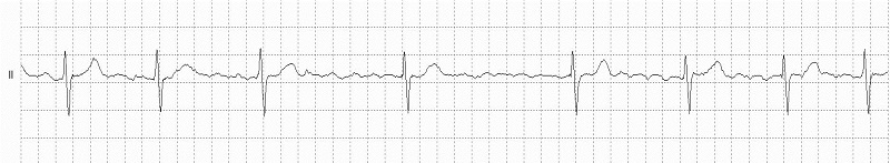 Atrial Fibrillation Rhythm Strip